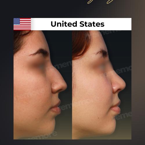 Perfiloplastia Foto antes/después